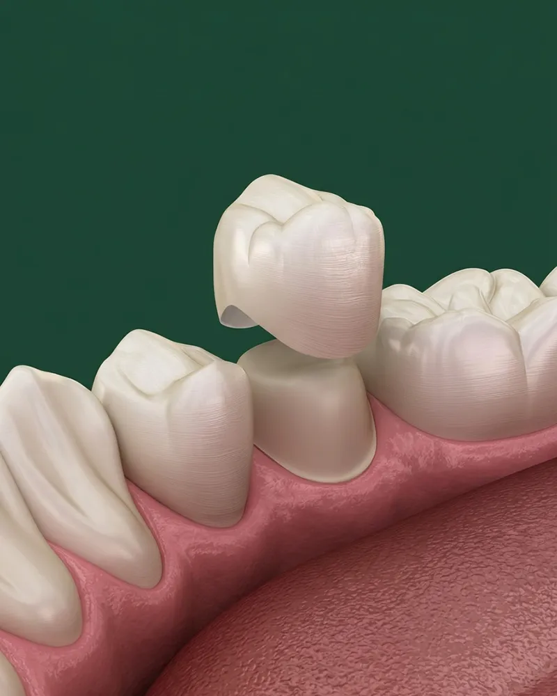 Dental Crown