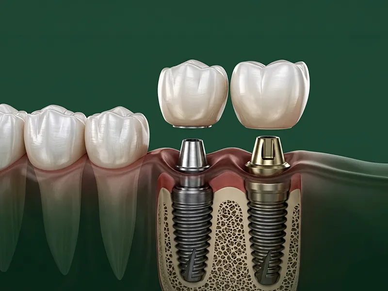 Dental-Implants General Dentistry