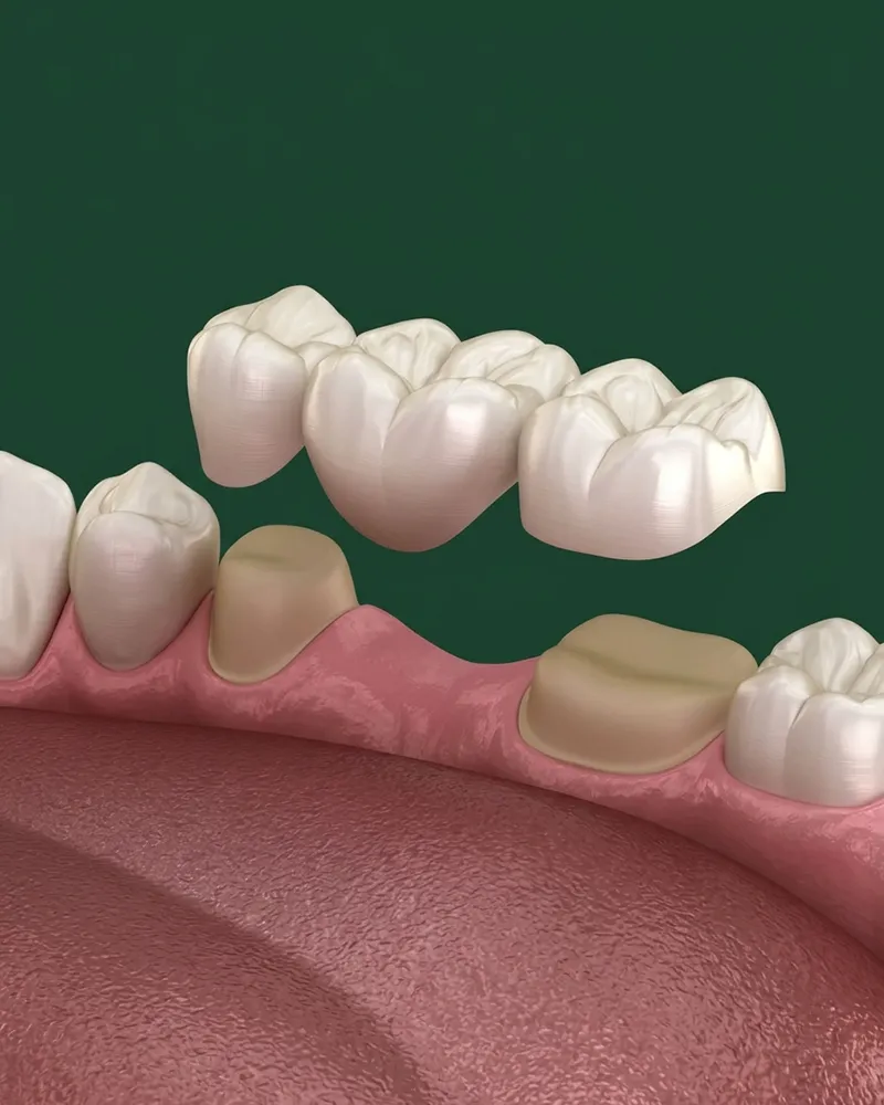 Dental bridge