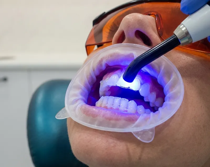 Teeth-Whitening Teeth Whitening