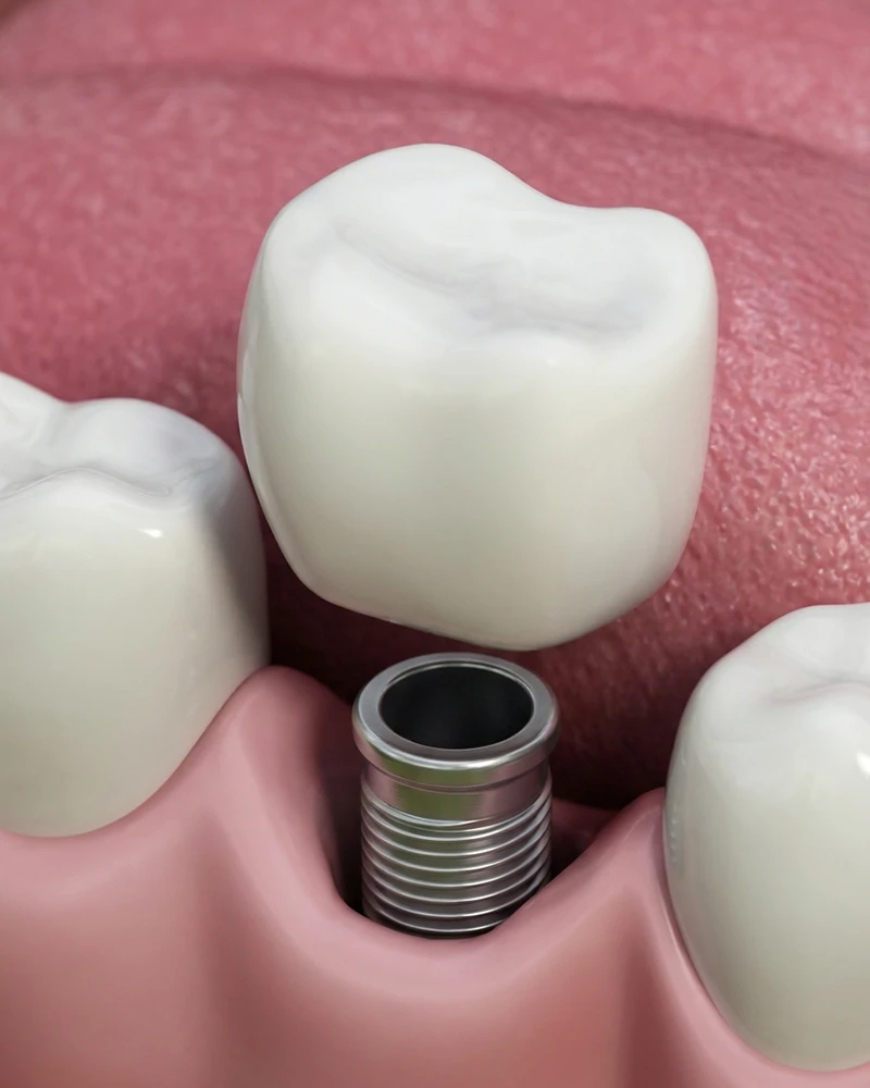 Dental Implant Patient
